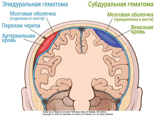 Операция по удалению гематомы головного мозга