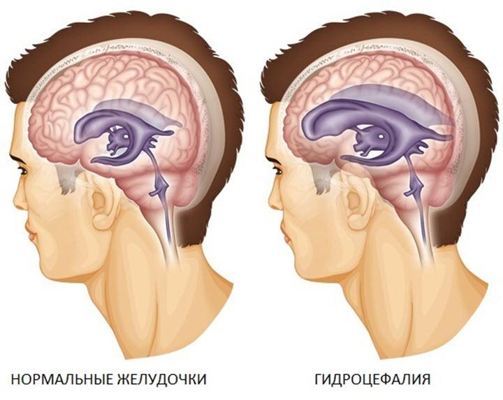 Гидроцефалия головного мозга симптомы