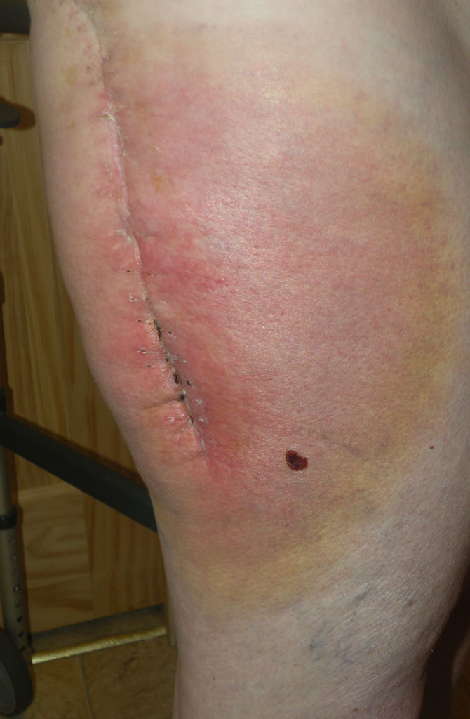 Изображение - Свищ на коленном суставе после операции 27-Trish-Swelling-670x1024