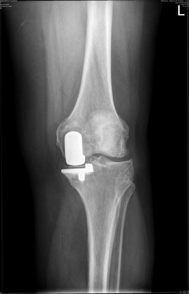 Рентген после частичной замены коленного сустава.