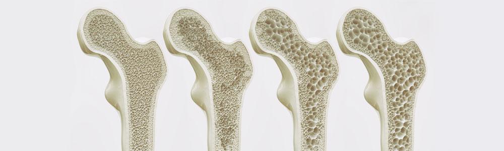 Эндопротезирование суставов при остеопорозе кости: риски операции при разных степенях
