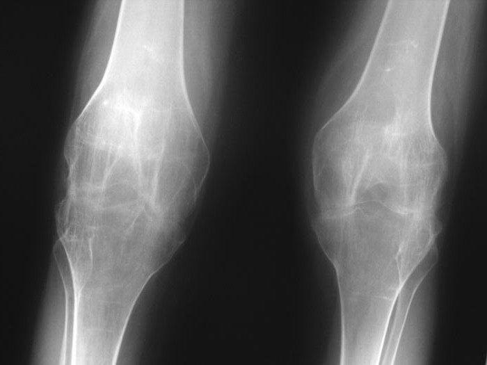Двухсторонний анкилоз коленного сустава
