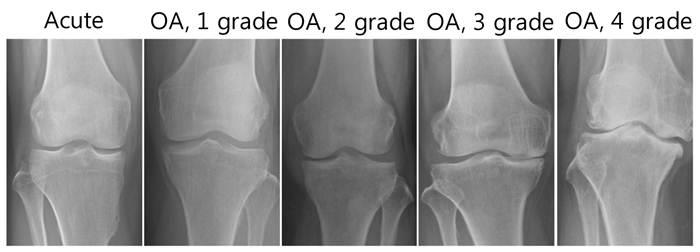 Стадии артрита коленного сустава на рентгене
