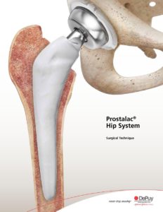 Prostalac® Hip System (DePuy)
