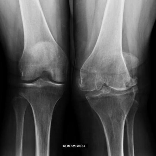 Операции при артрите коленного сустава: виды, стадии, подготовка и реабилитация