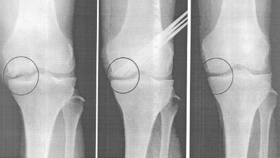 Артроскопия при артрозе (гонартрозе) коленного сустава: помогает или нет?