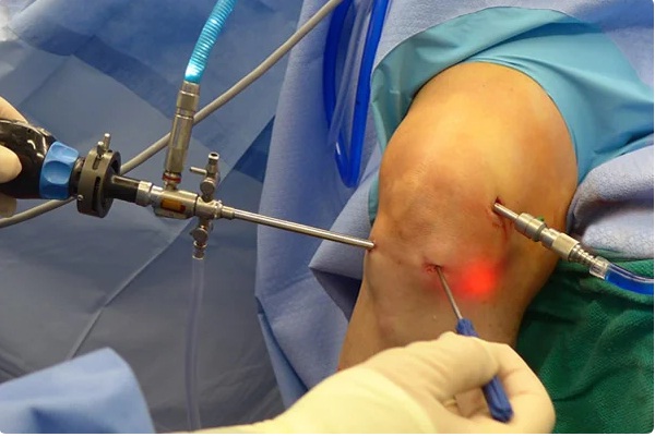 Артроскопия коленного сустава при повреждении менисков: описание методов и техник