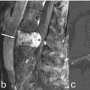 Aggressive vertebral hemangioma involving L1 vertebra in a 54 year old female with low Q320
